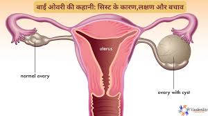 Photo of ओवेरियन सिस्ट जानकारी से ही बचाव संभव
