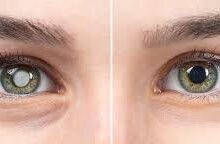 Photo of मुश्किल नहीं है मोतियाबिंद का इलाज