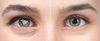 Photo of मुश्किल नहीं है मोतियाबिंद का इलाज