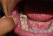 Photo of दांत-मसूड़ों के दर्द से छुटकारा पाने में काम आएंगे ये घेरलू उपाय..